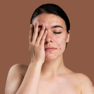 Peeling Químico